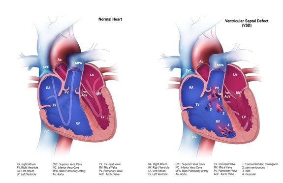 Finding out about Congenital Heart Defect